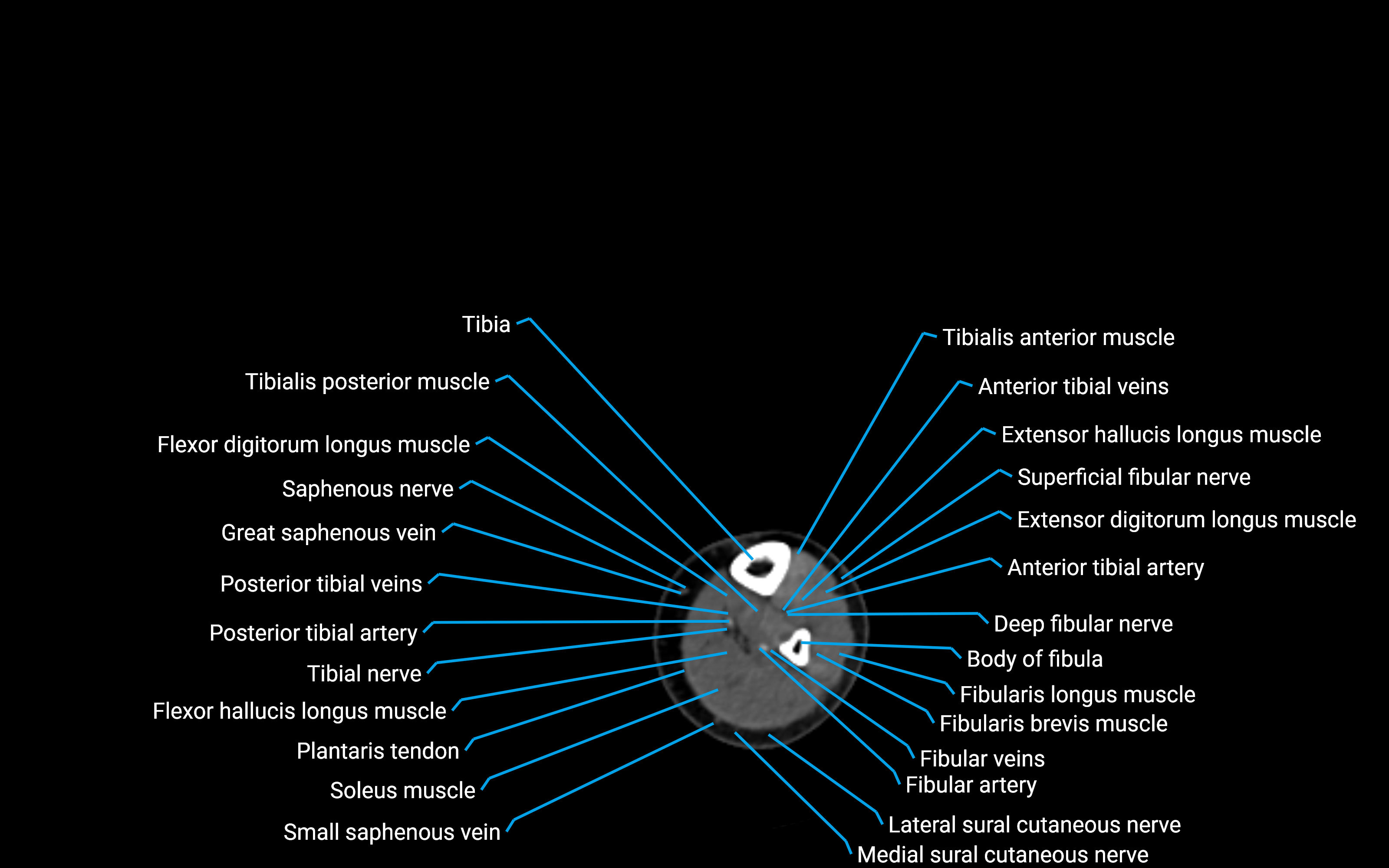 CT Lower leg axial cross sectional anatomy labelled image 135 (2).png